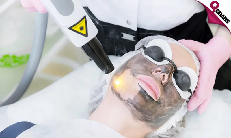 Carbon Laser Facial Treatment!